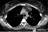 Mediastinal Teratoma